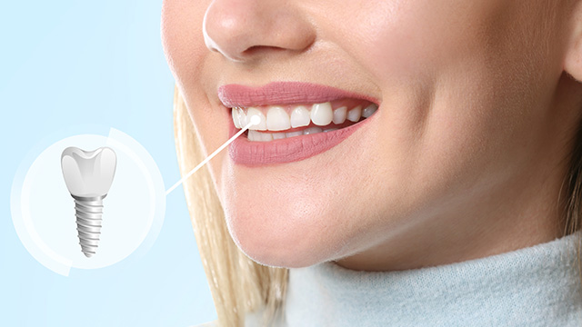 The image displays a woman with a radiant smile, showcasing her teeth, which are highlighted by a dental implant advertisement featuring a screw-like design.